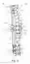 Fig. 09 - Spinal correction and secondary stabilization