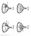 Fig. 16 - Methods and devices for treating pelvic conditions