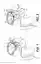 Fig. 02 - Tissue extraction devices and related methods