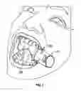Fig. 02 - Intraoral device and method of use
