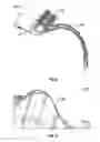 Fig. 10 - Intraoral device and method of use