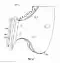 Fig. 11 - Intraoral device and method of use