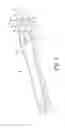 Fig. 02 - Surgical tool and system adapted to place a cuff of an artificial urinary sphincter around a portion of a urethra