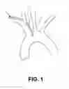 Fig. 02 - Method of isolating the cerebral circulation during a cardiac procedure
