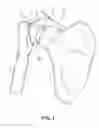Fig. 02 - MULTI-COMPONENT SHOULDER IMPLANT ASSEMBLY WITH DUAL ARTICULATING SURFACES
