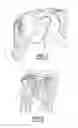 Fig. 05 - MULTI-COMPONENT SHOULDER IMPLANT ASSEMBLY WITH DUAL ARTICULATING SURFACES