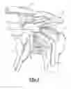 Fig. 06 - MULTI-COMPONENT SHOULDER IMPLANT ASSEMBLY WITH DUAL ARTICULATING SURFACES