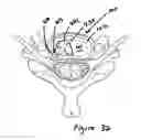 Fig. 22 - Devices and methods for treating tissue defects