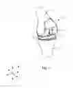 Fig. 02 - SYSTEMS AND METHODS FOR MOBILE BEARING PROSTHETIC KNEE