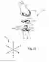 Fig. 24 - SYSTEMS AND METHODS FOR MOBILE BEARING PROSTHETIC KNEE