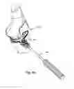 Fig. 44 - SYSTEMS AND METHODS FOR MOBILE BEARING PROSTHETIC KNEE