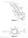 Fig. 02 - INTRAUTERINE DEPOSIT