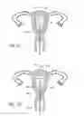 Fig. 04 - Intrauterine contraceptive device