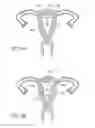 Fig. 07 - Intrauterine contraceptive device