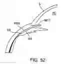 Fig. 32 - Glaucoma treatment device