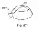 Fig. 37 - Glaucoma treatment device