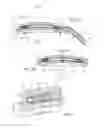 Fig. 04 - Apparatus and methods for treating excess intraocular fluid