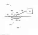 Fig. 02 - Provision of wound filler