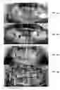 Fig. 04 - Formulation for regeneration of bone, cartilage, teeth, and periodontium and treatment of tumors and cysts