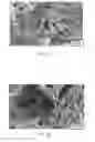 Fig. 09 - ORTHOPEDIC USE OF A HYDROGEL COMPOSITION