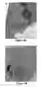 Fig. 08 - Nanoparticle therapy in cancer