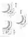 Fig. 12 - Ventricular cuff