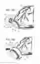 Fig. 14 - Ventricular cuff