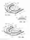 Fig. 17 - Ventricular cuff