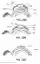 Fig. 40 - Ventricular cuff