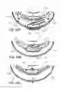 Fig. 41 - Ventricular cuff