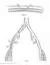 Fig. 02 - Bidirectional Introducer Catheter