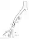 Fig. 09 - Bidirectional Introducer Catheter