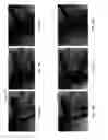 Fig. 10 - CANTILEVER ELECTRODES FOR TRANSDERMAL AND TRANSCRANIAL STIMULATION