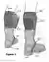 Fig. 06 - Foot orthosis and exoskeleton