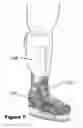 Fig. 08 - Foot orthosis and exoskeleton