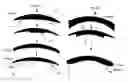 Fig. 01 - Method for reducing the thickness of a lens shape and uncut lens blank