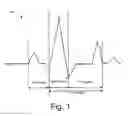 Fig. 02 - QRS complex identification in electrocardiogram signals
