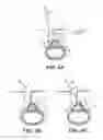 Fig. 06 - Multiple pathways for spinal nerve root decompression from a single access point