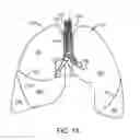 Fig. 02 - MEDICAL DEVICES AND METHODS FOR LUNG VOLUME REDUCTION