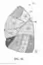 Fig. 04 - MEDICAL DEVICES AND METHODS FOR LUNG VOLUME REDUCTION