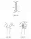 Fig. 06 - MEDICAL DEVICES AND METHODS FOR LUNG VOLUME REDUCTION