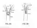 Fig. 09 - MEDICAL DEVICES AND METHODS FOR LUNG VOLUME REDUCTION