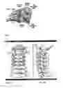 Fig. 02 - Lateral mass fixation system