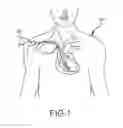 Fig. 02 - Surgical instrument for removing an implanted object