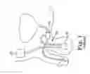 Fig. 02 - Surgical system for and a method of identifying an incision site