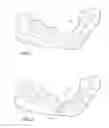 Fig. 02 - Autografting osteotome