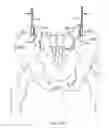 Fig. 29 - Systems for and methods of diagnosing and treating a sacroiliac joint disorder