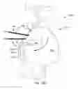 Fig. 35 - Systems for and methods of diagnosing and treating a sacroiliac joint disorder