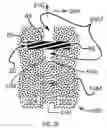 Fig. 61 - Systems for and methods of diagnosing and treating a sacroiliac joint disorder