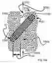 Fig. 65 - Systems for and methods of diagnosing and treating a sacroiliac joint disorder